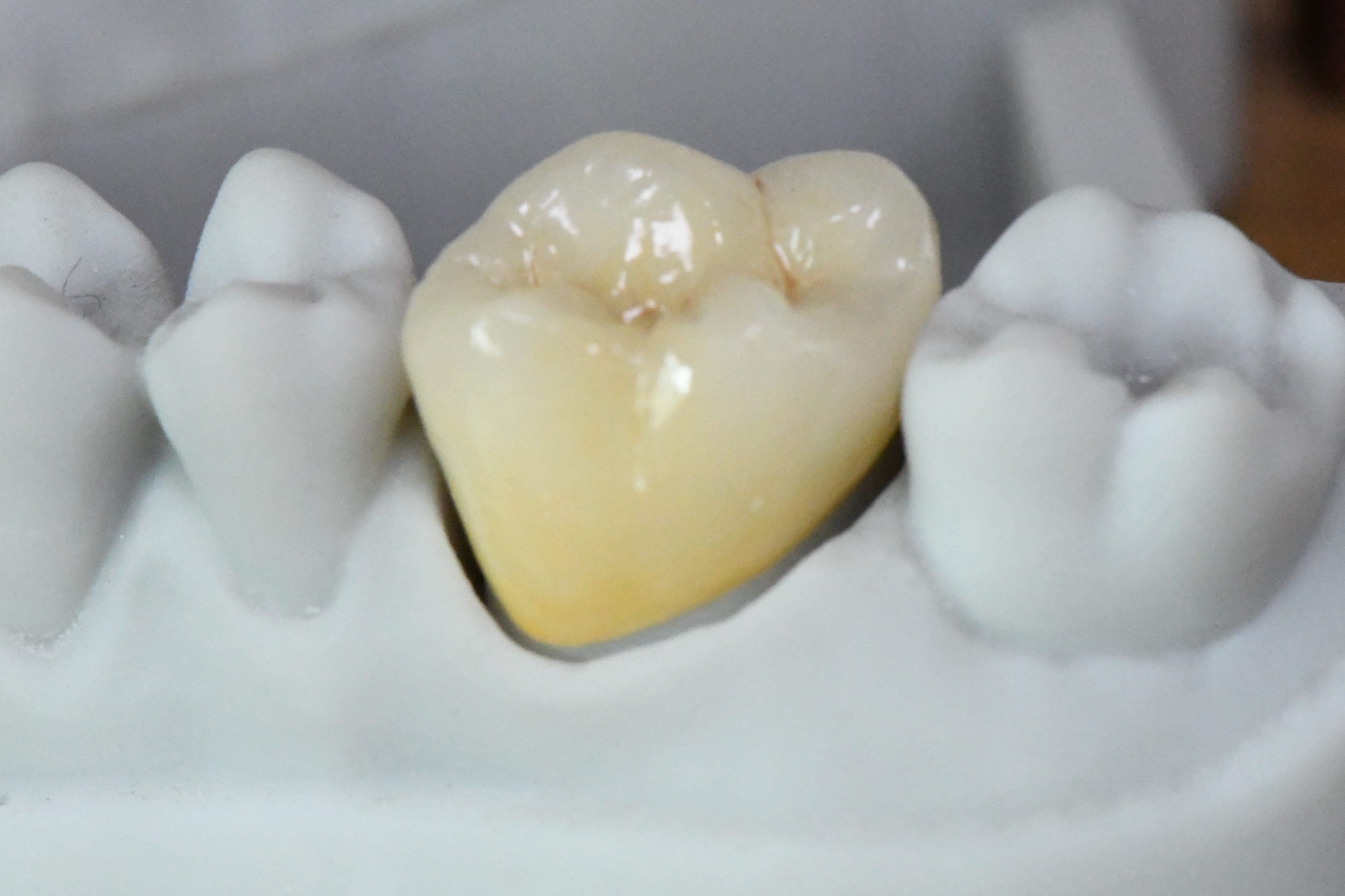All Ceramic